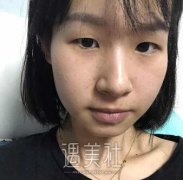 韩式翘睫毛双眼皮实图分享，眼睛瞬间大了十倍! width=