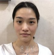 冷光子嫩肤果怎么样?有冷光子嫩肤真实案例吗? width=