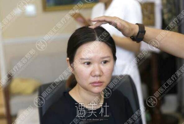 鼻翼缩小对比图片分享——鼻翼缩小真实案例来袭~
