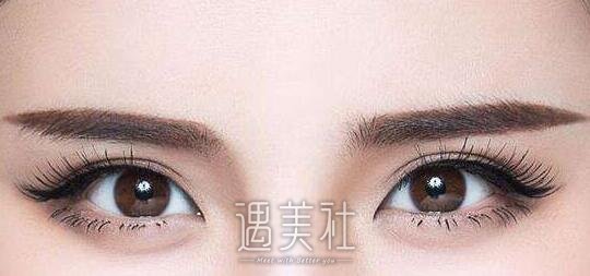 开大眼角手术