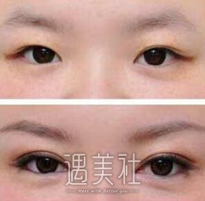 开大眼角手术