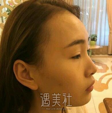 福州,武警整形,注射瘦脸