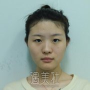 埋线双眼皮修复是怎么做的|埋线双眼皮修复的过程分享～ width=