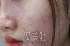 激光调节痤疮果怎么样？有激光调节痤疮真实案例吗？ width=