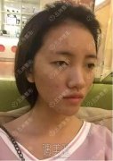 胶原蛋白隆鼻术果到底好不好|胶原蛋白隆鼻术案例力证~ width=