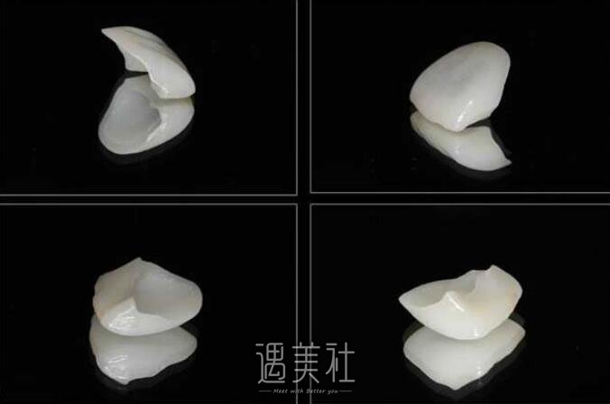 亳州做全瓷牙贴面大概多少钱?费用一般在哪个区间?