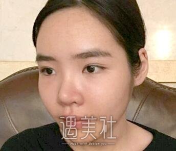 广州,曙光,万友望,脂肪填充
