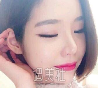 广州,曙光,万友望,脂肪填充