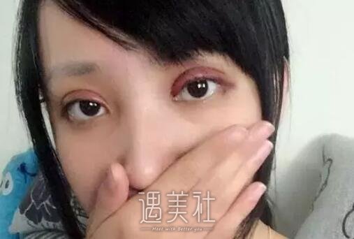 金云波双眼皮真实案例分享，看看她的变美历程!
