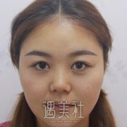 耳后软骨隆鼻真实案例：鼻子还是高高挺挺的好看呐~ width=