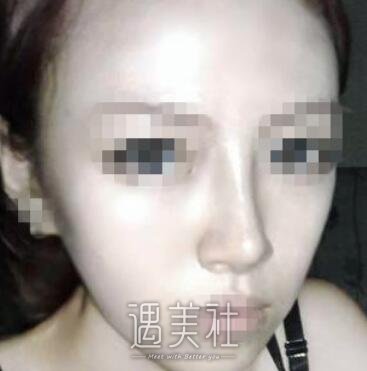 耳软骨隆鼻尖