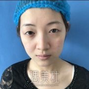 李长江双眼皮案例：拯救小眼无神 width=