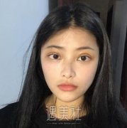 袁湘彬双眼皮案例：术后自然微创哦~ width=