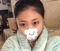 韩式埋线双眼皮果真的好吗|韩式埋线双眼皮案例力证~ width=