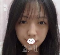 赵耀忠双眼皮案例：同事们说我的眼睛恢复的特别好 width=
