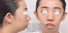 章建林正颌手术案例：改变了我的面部轮廓 width=