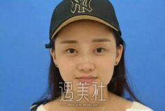 徐剑炜双眼皮案例：如今这大眼睛贼美 width=