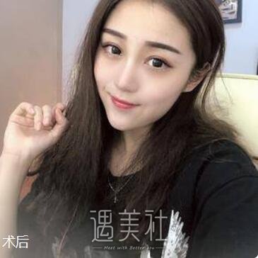 刘滢,光子嫩肤