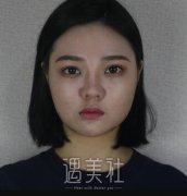 下颌角削骨手术怎么做，去年才做过的我想来分享下经历~ width=