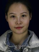 瓜子脸手术改造的图片分享|瓜子脸手术改造真实经历分享~ width=