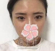 内双做双眼皮果好吗？内双做双眼皮真实案例傲娇上线~ width=