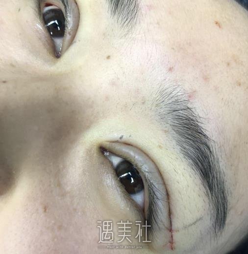 平煤总医院,割双眼皮