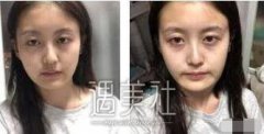 下颌角吸脂照片对比：真的变成瓜子脸了，灰常开森~ width=