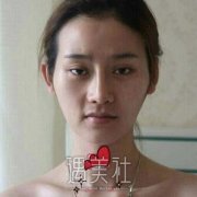 任思雨整形医生技术过硬吗?有任思雨近期崭新案例看看嘛? width=