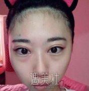眼睛泪沟脂肪填充案例：减龄的秘密武器哟~ width=