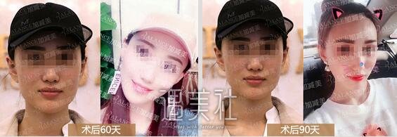 黄寅守,下颌角截骨