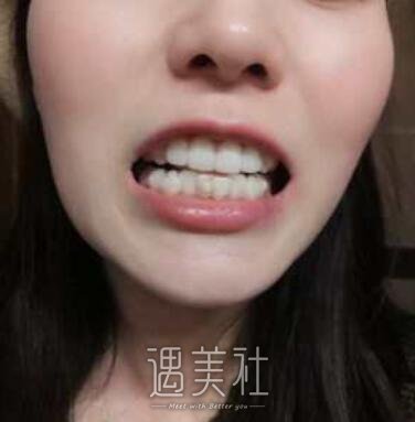 牙齿矫正