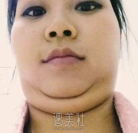运城面部吸脂修复一般要多少钱?有哪些直接影响因素呢?