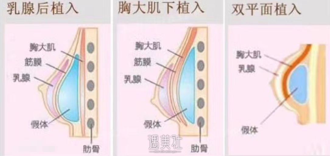美国妙桃假体隆胸费用大约是多少?价钱啥区间比较合理?