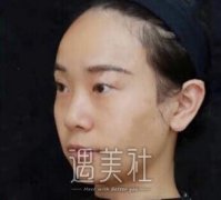 注射玻尿酸丰面颊果怎么样|注射玻尿酸丰面颊案例力证~ width=