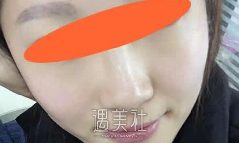 河北,现代女子,祛斑