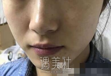 河北,现代女子,祛斑