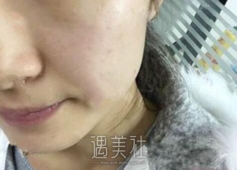 河北,现代女子,祛斑