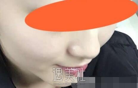 河北,现代女子,祛斑