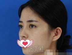 注射玻尿酸丰面颊果好吗？看注射玻尿酸丰面颊真实案例~ width=