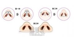 南阳做内切鼻翼缩小手术大概多少钱?我要准备多少预算安~ width=