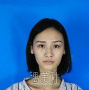 黄郁医生给我做了脂肪填充额头后，整个面部都饱满了呢~ width=