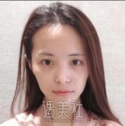 全脸脂肪填充几天消肿?我想用亲身经历来回答下这个问题~ width=