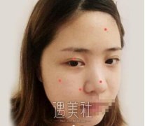 开眼尾前后对比果照片分享：开眼尾和开眼角还有这区别~ width=