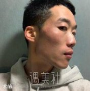 男人隆鼻早已不是什么新鲜事儿，来看看这位男生的故事~ width=