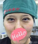 双眼皮宽度6mm恢复后果照片分享|双眼皮宽度6mm案例分享~ width=