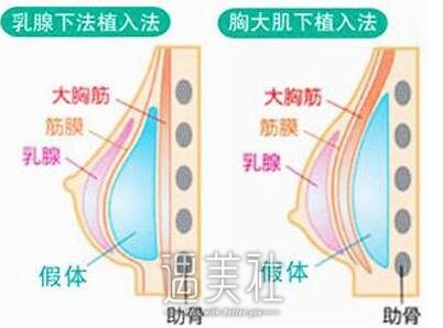 武汉硅胶隆胸手术价格一般要多少?听小编慢慢来分析下~