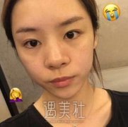 鼻头肥大矫正术案例：精致的小翘鼻才是更适合我的喃~ width=