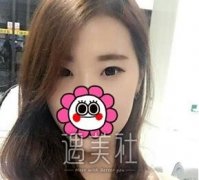 开后眼角照片对比：原来开后眼角的作用竟是如此之大啊~ width=