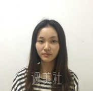宽鼻矫正恢复过程图分享：一个勇敢妹子蜕变的真实记录~ width=