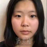 沧州美神做双眼皮技术好么?这里有一篇案例硬核回应~ width=